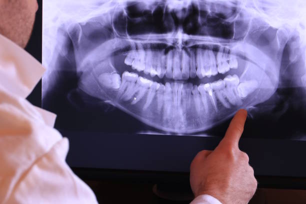 Best Emergency Wisdom Teeth Removal in North Tonawanda, NY